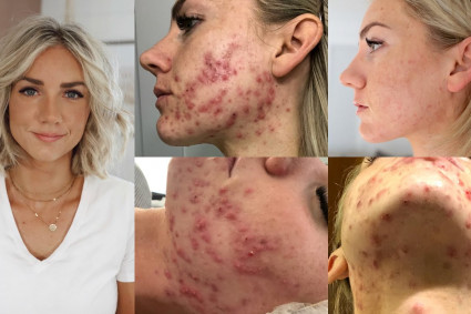 How I Cured My Adult Hormonal Cystic Acne Naturally (no accutane)